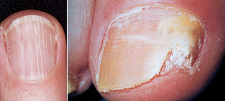 nehty plisen ryhy lamavost byliny bylinky babske rady olej koupel tinktura